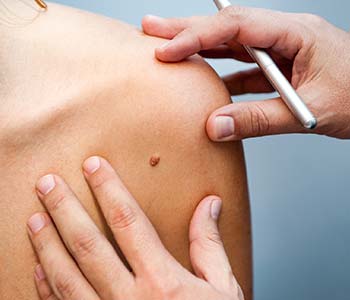 What is surgical dermatology in Katy, TX recommended for?