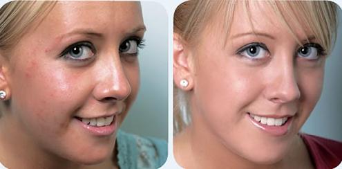 Acne Scar Removal - Before and After
