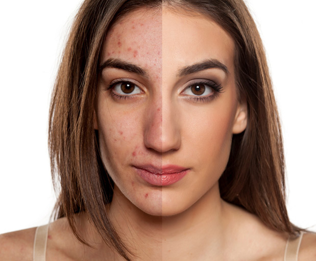 Woman's Face After Treatement for Acne