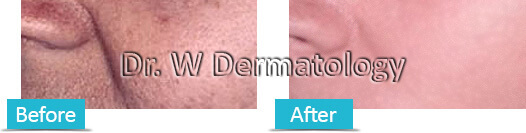 Chemical Peels Before After