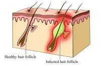 Folliculitis