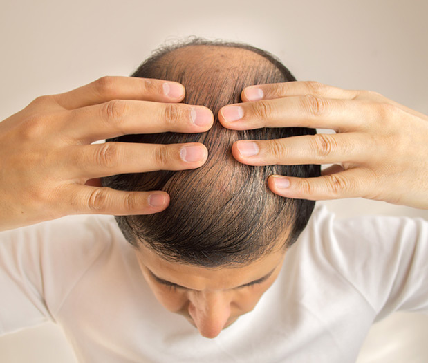 Hair loss