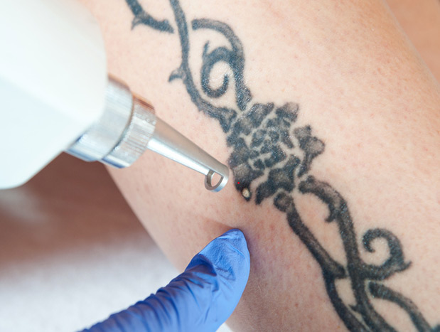 Laser tattoo removal
