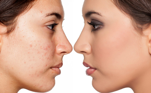 Problematic skin without and with makeup