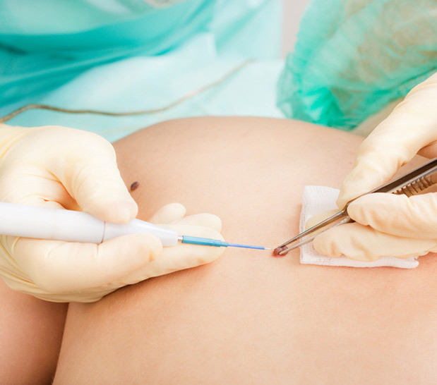 Mole Removal