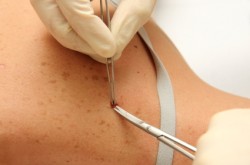 Mole Removal Procedure