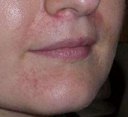 Perioral Dermatitis