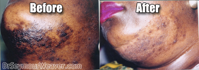 Pseudo-folliculitis Barbae before and after laser treatment