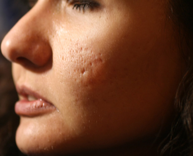 Inflamed skin of the face in pimples and acne.