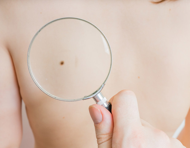 Doctor holds magnifying glass and examining patient skin