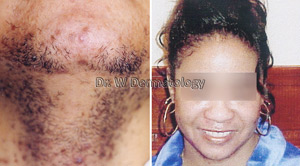 Laser Treatments Before After 11
