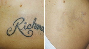 Tattoo Removal Before After 01
