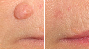 Mole Removal Before After 02