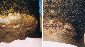Keloids Before After 01