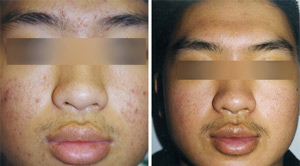 Before After Acne 09