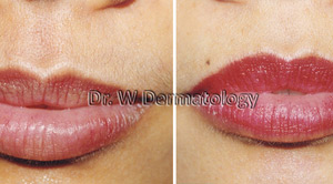 Laser Treatments Before After 05
