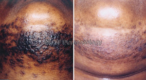 Laser Treatments Before After 04