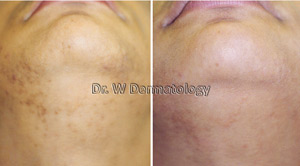 Laser Treatments Before After 03