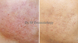 Laser Treatments Before After 10