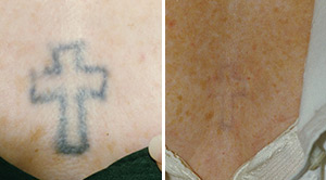 Tattoo Removal Before After 02