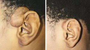 Keloids Before After 02