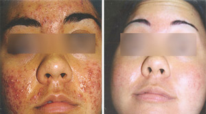 Before After Acne 08