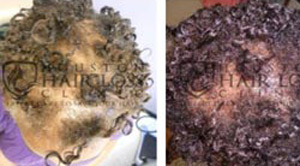 PRP Before After