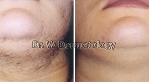 Laser Treatments Before After 01