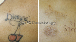 Tattoo Removal Before After 03