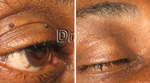 Mole Removal Before After 03