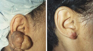 Keloids Before After 03