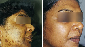 Before After Acne 07