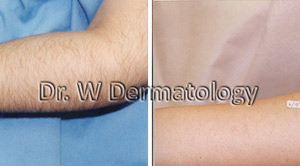 Laser Treatments Before After 02
