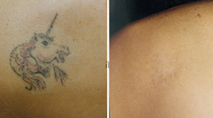 Tattoo Removal Before After 04