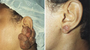 Keloids Before After 05