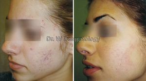 Before After Acne 06