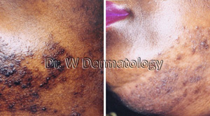 Laser Treatments Before After 03