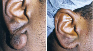 Keloids Before After 05