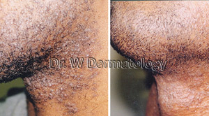 Laser Treatments Before After 04
