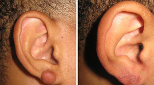 Keloids Before After 06