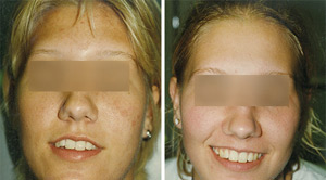 Before After Acne 04