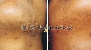 Laser Treatments Before After 05