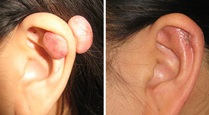 Keloids Before After 07
