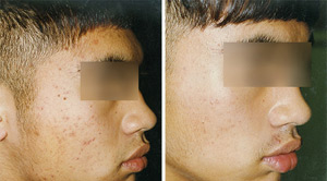 Before After Acne 03