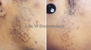 Laser Treatments Before After 05