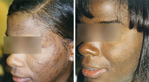Acne Before After 01