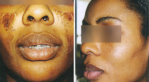 Acne Before After 10