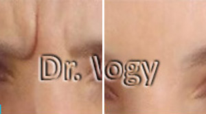 Botox Before After