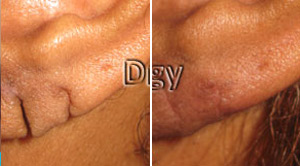 Earlobe Before After
