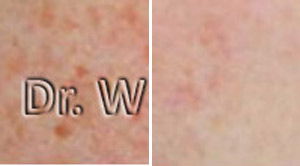 Freckels Before After
